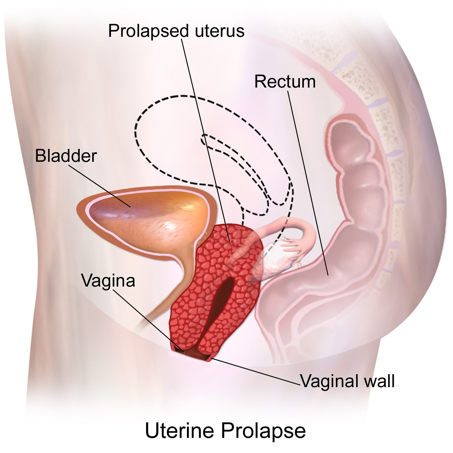 Prolapse Treatment Mumbai