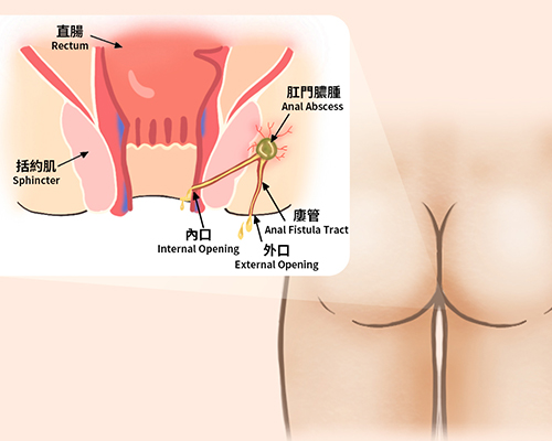 Abscess Treatment Mumbai