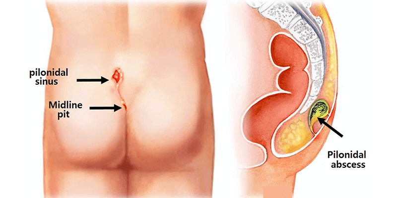 Pilonidal Sinus Mumbai