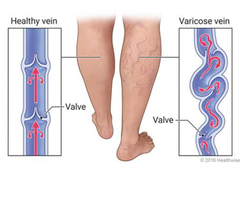 Varicose Veins Mumbai